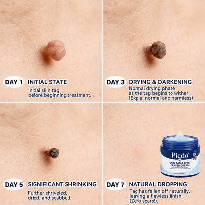𝐏𝐢𝐜𝐝𝐨®𝐂𝐫è𝐦𝐞 𝐄𝐟𝐟𝐚𝐜𝐞𝐮𝐫 𝐝’𝐀𝐜𝐫𝐨𝐜𝐡𝐨𝐫𝐝𝐨𝐧𝐬 & 𝐝𝐞 𝐓𝐚𝐜𝐡𝐞𝐬 – 𝟕 𝐉𝐨𝐮𝐫𝐬 (𝐅𝐨𝐫𝐦𝐮𝐥𝐞 𝐙é𝐫𝐨 𝐃𝐨𝐮𝐥𝐞𝐮𝐫, 𝐙é𝐫𝐨 𝐂𝐢𝐜𝐚𝐭𝐫𝐢𝐜𝐞) 🌹