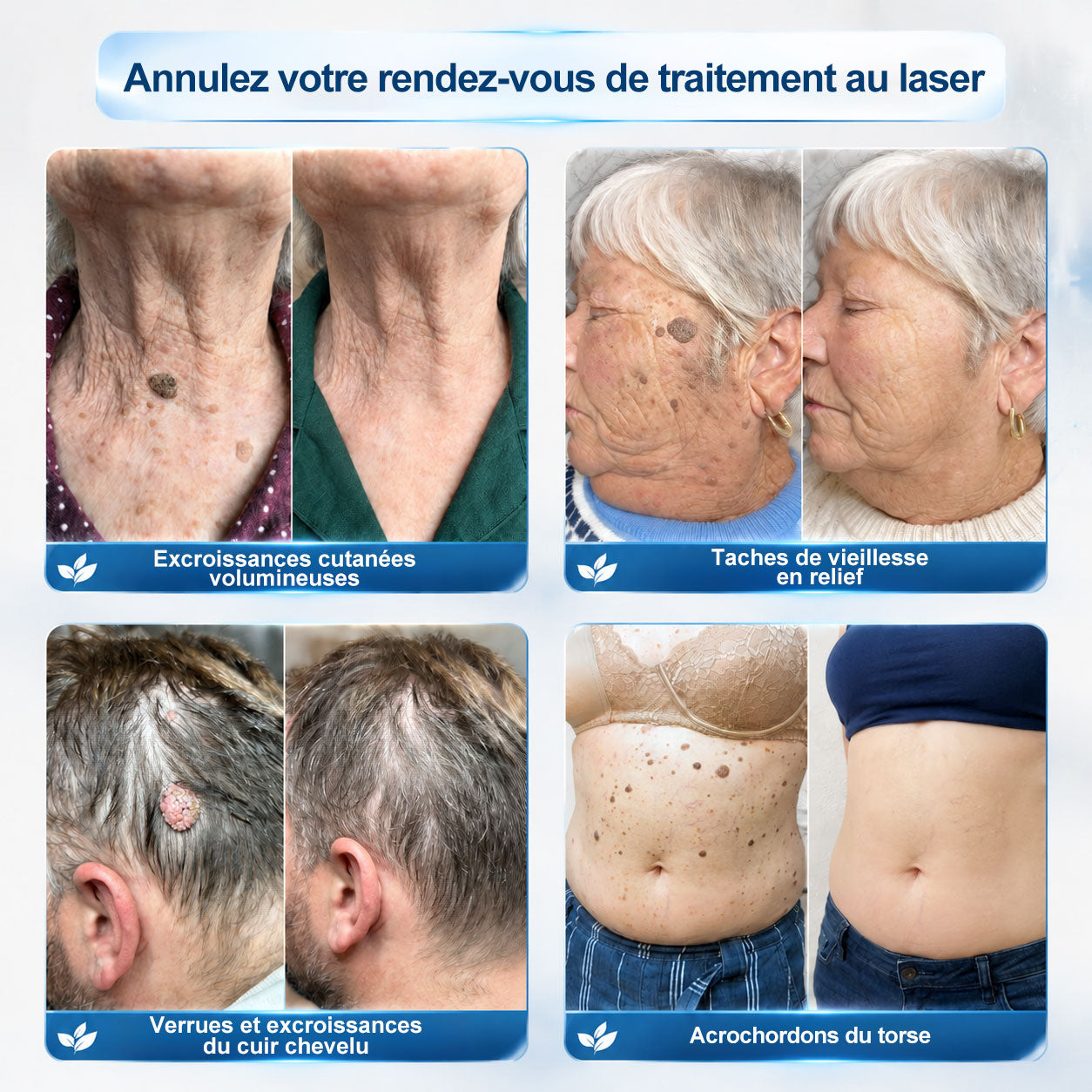 Boutique officielle de la marque |🔥𝐏i𝐜𝐝o® 7 Jours Effaceur de taches et d’excroissances cutanées(Zéro douleur, zéro cicatrice – Roller)💎