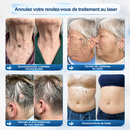 Boutique officielle de la marque |🔥𝐏i𝐜𝐝o® 7 Jours Effaceur de taches et d’excroissances cutanées(Zéro douleur, zéro cicatrice – Roller)💎