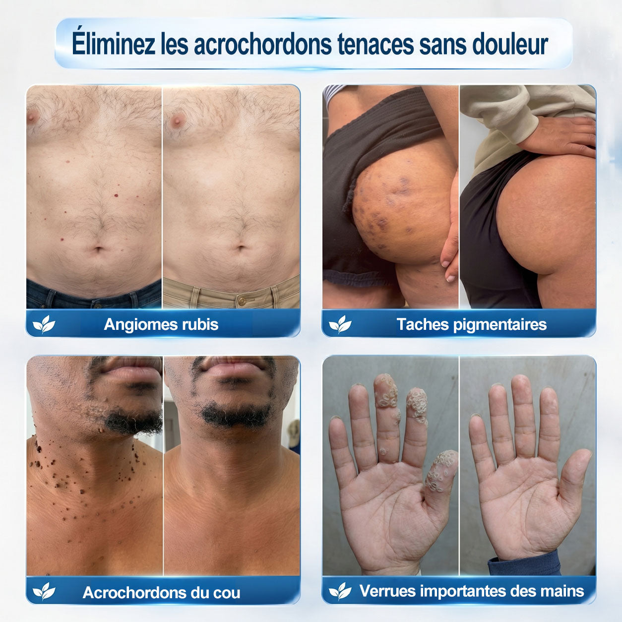 Boutique officielle de la marque |🔥𝐏i𝐜𝐝o® 7 Jours Effaceur de taches et d’excroissances cutanées(Zéro douleur, zéro cicatrice – Roller)💎