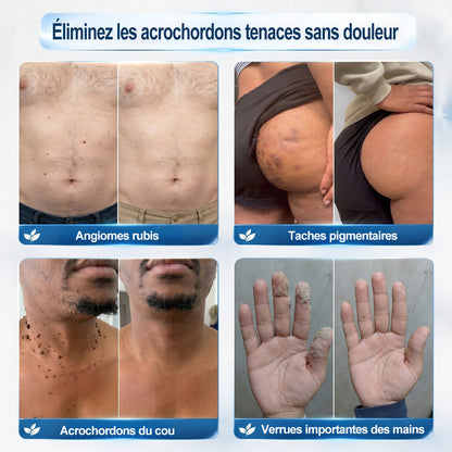 Boutique officielle de la marque |🔥𝐏i𝐜𝐝o® 7 Jours Effaceur de taches et d’excroissances cutanées(Zéro douleur, zéro cicatrice – Roller)💎
