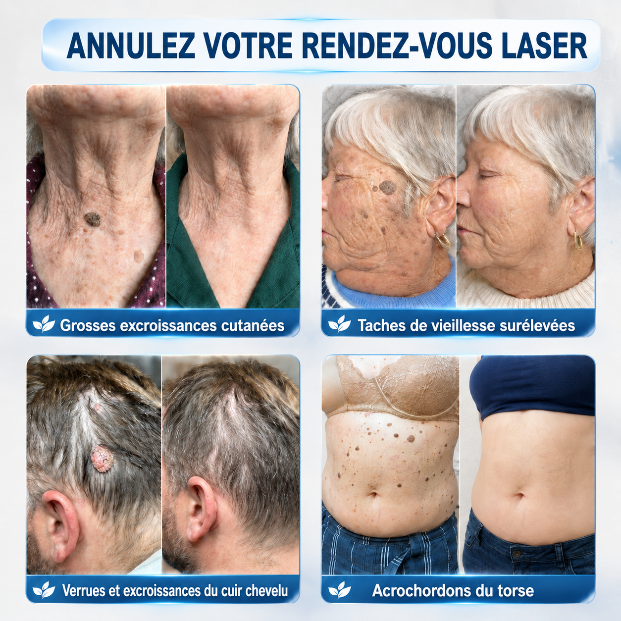 𝐵o𝑢𝑡𝑖𝑞𝑢𝑒 O𝑓𝑓𝑖𝑐𝑖𝑒𝑙𝑙𝑒✅𝑵𝒆𝒌𝒊𝒔𝒔®🚀𝑴𝒊𝐜𝐫𝐨𝒏𝐞𝐞𝒅𝒍𝒆𝒔 𝑷𝒆𝒂𝒖 𝑷𝒂𝒓𝒇𝒂𝒊𝒕𝒆 É𝒍𝒊𝒎𝒊𝒏𝒂𝒕𝒊𝒐𝒏 𝑫𝒆𝒔 𝑽𝒆𝒓𝒓𝒖𝒆𝒔 𝑷𝒂𝒕𝒄𝒉 (𝑃𝑜𝑢𝑟 𝑙𝑒𝑠 𝑎𝑐𝑟𝑜𝑐ℎ𝑜𝑟𝑑𝑜𝑛𝑠, 𝑙𝑒𝑠 𝑝𝑒𝑡𝑖𝑡𝑒𝑠 𝑒𝑥𝑐𝑟𝑜𝑖𝑠𝑠𝑎𝑛𝑐𝑒𝑠 𝑐𝑢𝑡𝑎𝑛é𝑒𝑠, 𝑙𝑒𝑠 𝑣𝑒𝑟𝑟𝑢𝑒𝑠, 𝑙𝑒𝑠 𝑔𝑟𝑎𝑖𝑛𝑠 𝑑𝑒 𝑏𝑒𝑎𝑢𝑡é, 𝑙𝑒𝑠 𝑡𝑎𝑐ℎ𝑒𝑠 𝑑𝑒 𝑣𝑖𝑒𝑖𝑙𝑙𝑒𝑠𝑠𝑒 𝑒𝑡 𝑙𝑒𝑠 𝑝𝑟𝑜𝑏𝑙è𝑚𝑒𝑠 𝑑𝑒 𝑝𝑖𝑔𝑚𝑒𝑛𝑡𝑎𝑡𝑖𝑜𝑛)